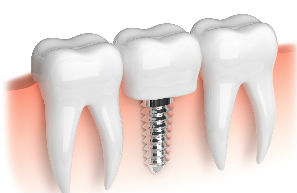 Implant Restoration | Dr. Vondell | Cedar Crest Dental Center | Lebanon, PA Dentist